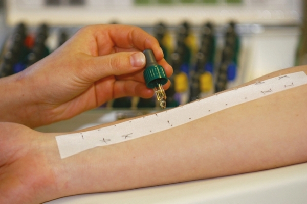 Bei einer Person wird ein Allergietest am Arm durchgeführt.